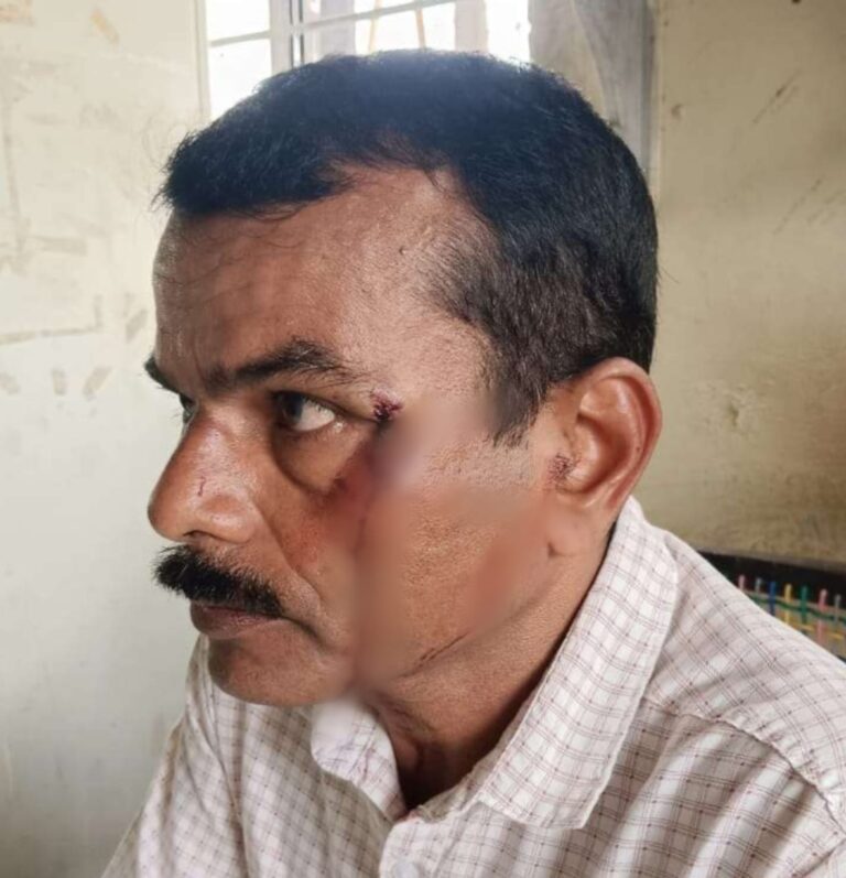 ಮೆಸ್ಕಾಂ ಅಪರೇಟರ್ ಮೇಲೆ ಮೆಸ್ಕಾಂ ಎ.ಇ ಸುಪ್ರಿತ್ ಹಲ್ಲೆ ನಡೆಸಿ ರಕ್ತ ಗಾಯ